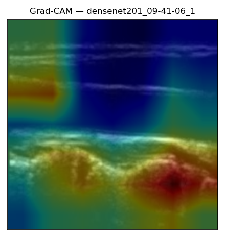 Grad-CAM overlay on a carotid B-mode frame