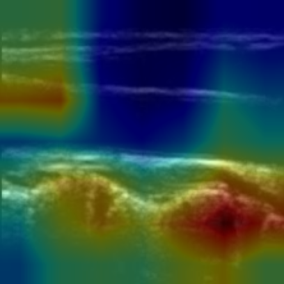 Grad-CAM overlay on carotid B-mode image 09-41-06_1: the heatmap sits on the vessel-wall boundary.
