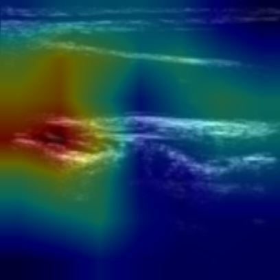 Grad-CAM overlay on carotid B-mode image 09-46-10_1: the heatmap sits on the vessel-wall boundary.