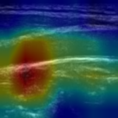 Grad-CAM overlay on carotid B-mode image 09-53-51: the heatmap sits on the vessel-wall boundary.