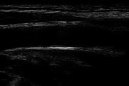 Longitudinal grayscale B-mode image of a common carotid artery — the static fallback for the interactive Doppler-angle explainer.